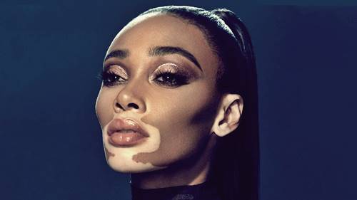 Penderita Vitiligo juga dipengaruhi Melanin dalam tubuhnya