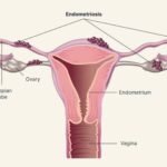 Endometriosis, Penyakit pada Jaringan Rahim yang Sering Terlambat Terdiagnosis