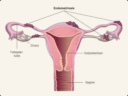 Endometriosis, Penyakit pada Jaringan Rahim yang Sering Terlambat Terdiagnosis